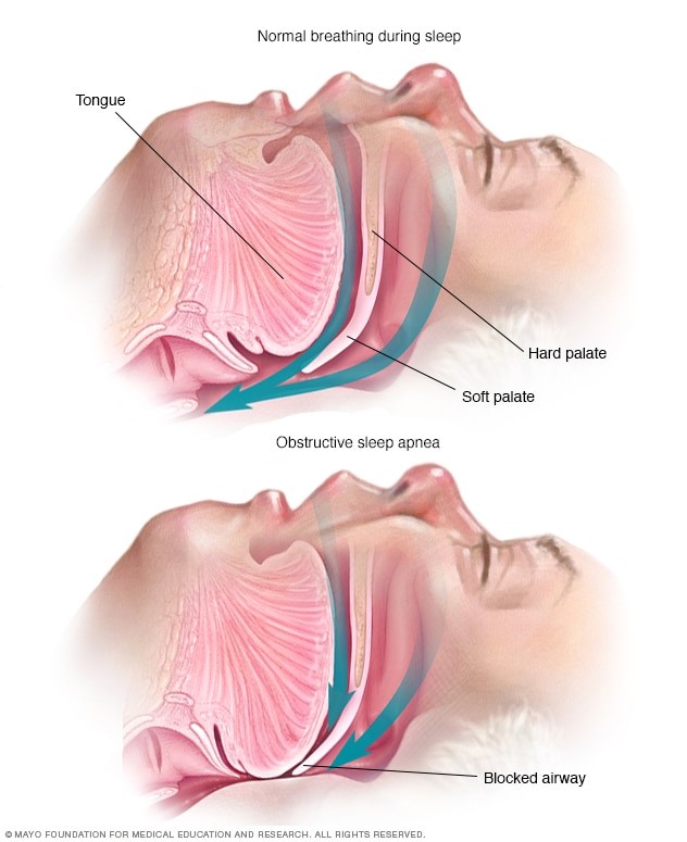 Obstructive Sleep Apnoea 1