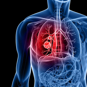 Lung Nodule 1