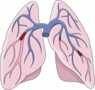 large pulmonary embolism