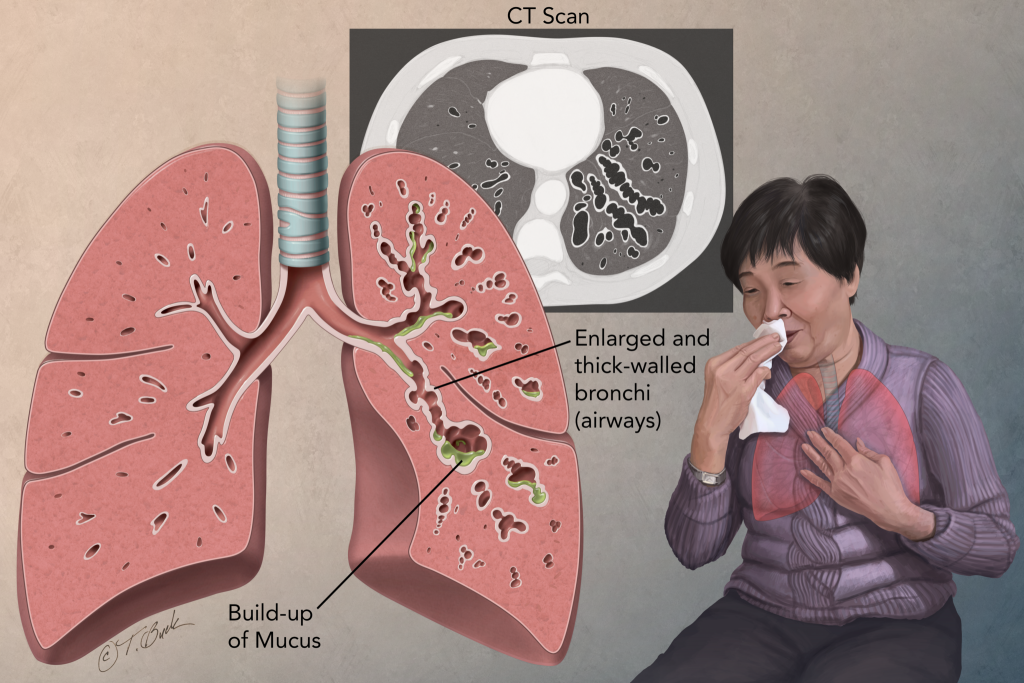 Bronchiectasis – Sleep and Lung Care