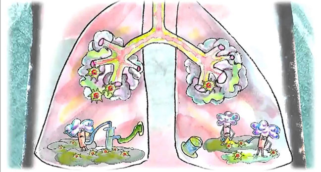 Bronchiectasis 2
