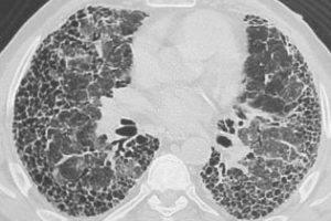 Chronic obstructive pulmonary disease (COPD), including emphysema 23