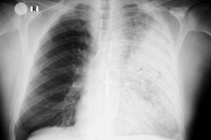 Pneumonia in adults (Bacterial chest infection) 16