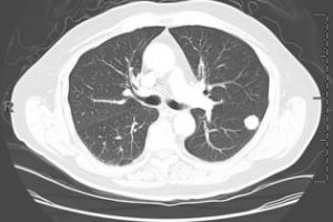 Pulmonary nodule (A spot on the lung) 7